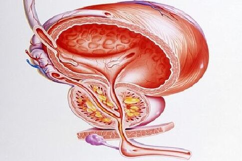 ropień prostaty jako wskazanie do operacji w przypadku zapalenia gruczołu krokowego
