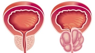 przyczyny rozwoju zapalenia gruczołu krokowego i gruczolaka prostaty